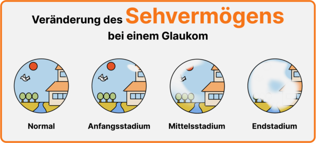 Veränderung des Sehvermögens bei einem Glaukom