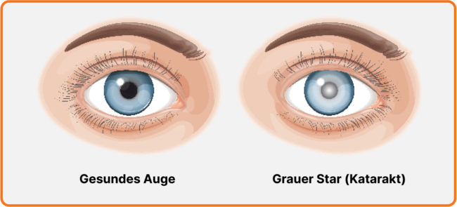 Trübung des Auges bei Katarakt (Grauer Star)